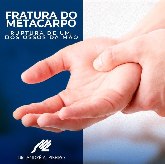 FRATURA DO METACARPO Dr André Ribeiro Ortopedista